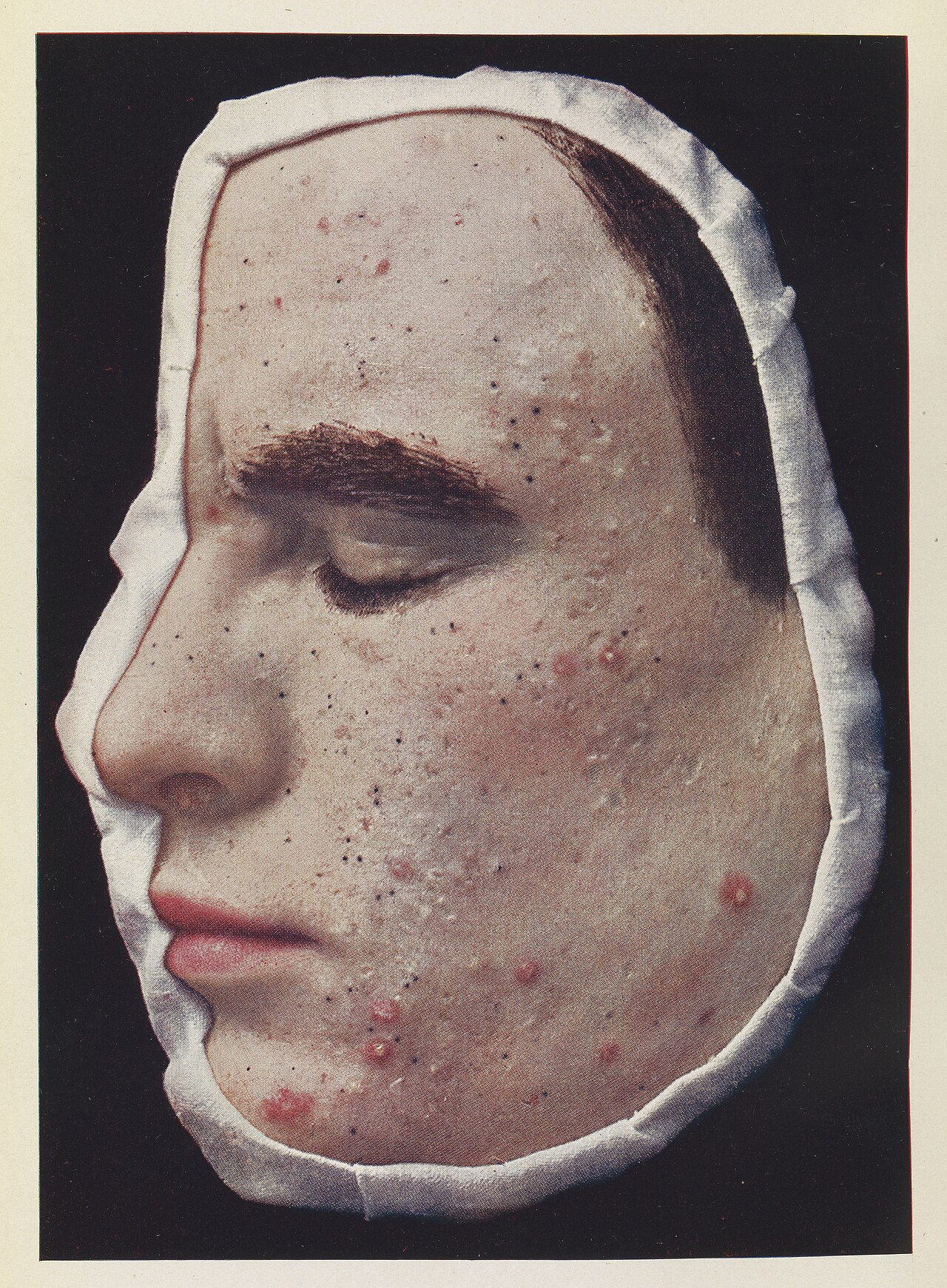 Acne