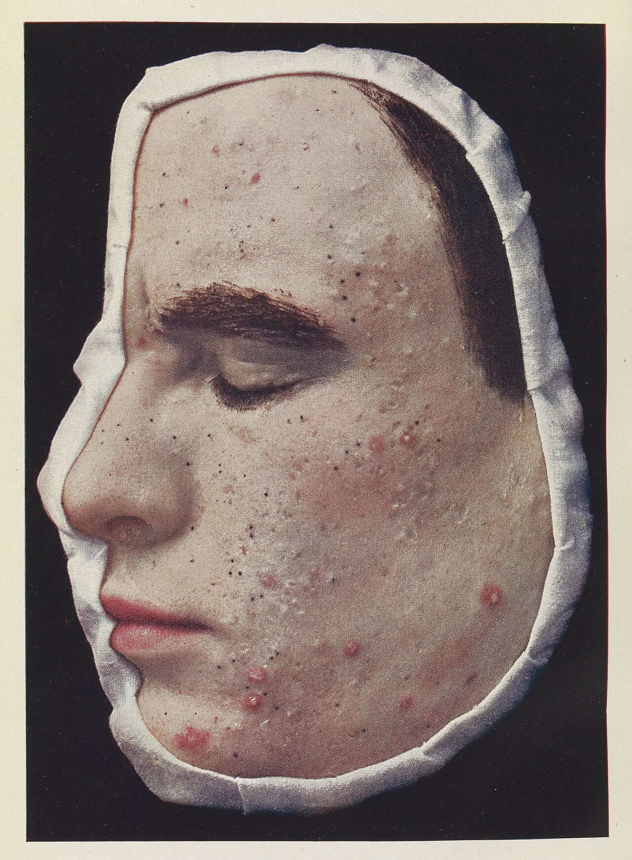 Acne