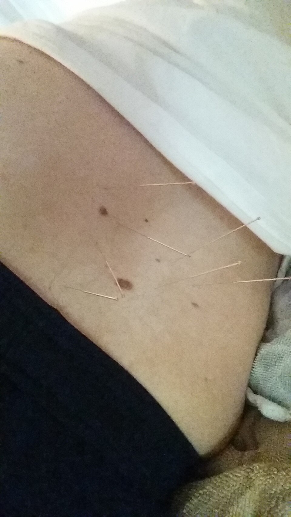 Acupuncture