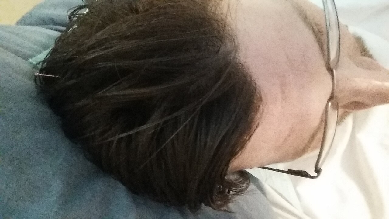 Acupuncture