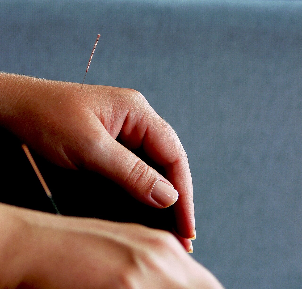 Acupuncture