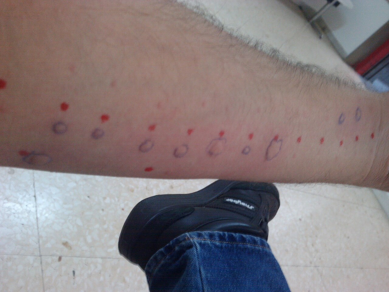 Allergy