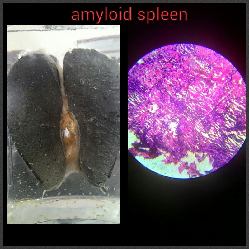 Spleen